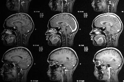 Найден способ победить неизлечимый рак мозга #Наука #Техника #Новости