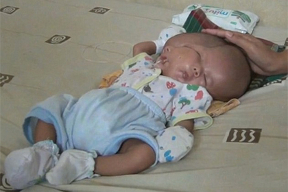 Ребенок с двумя лицами родился в Индонезии #Жизнь #Новости #Сегодня