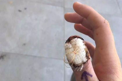 Привычка грызть ногти стоила студентке пальца #Жизнь #Новости #Сегодня