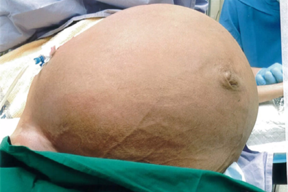 Вырастившая огромную опухоль женщина полгода терпела одышку из-за боязни врачей #Жизнь #Новости #Сегодня