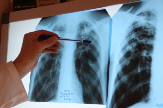 Заболеваемость туберкулезом в Омской области снизилась в 3 раза #Омск #Общество #Сегодня